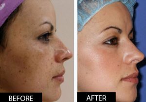Nasola Original Kojic Acid Soap for Hyperpigmentation Treatment Underarm Skin Lightening & Acne Dark Spot Whitening Body Tone Face & Armpit Bleaching photo review