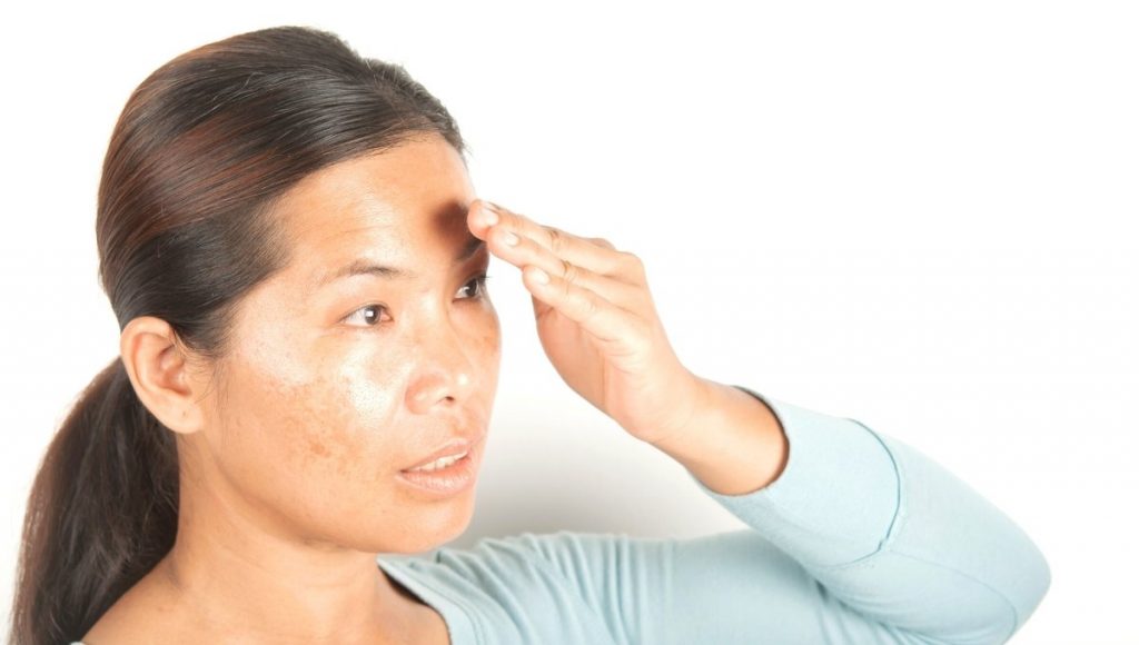 Treatment Options for Hyperpigmentation