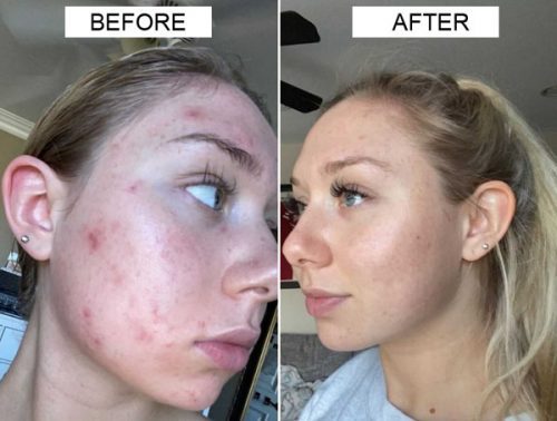 Nasola Kojic Acid Soap for Skin Brightening, Acne Dark Spot Remover for Face & Body, Underarm & Armpit, Fades Hyperpigmentation & Evens Tone photo review