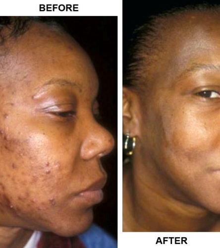 Nasola Original Kojic Acid Soap for Hyperpigmentation Treatment Underarm Skin Lightening & Acne Dark Spot Whitening Body Tone Face & Armpit Bleaching photo review