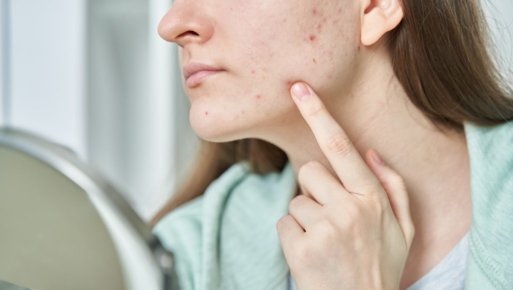 Consistency in Korean Skincare Rituals That Fade Acne Scars and Hyperpigmentation