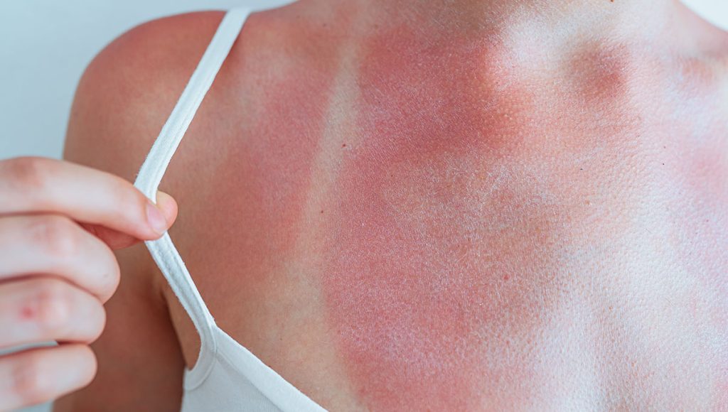 Best Essential Oil for Sunburn Natural Relief for Soothing Damaged Skin