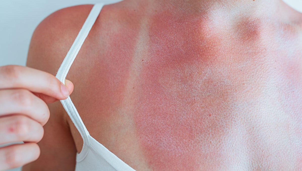 Best Essential Oil for Sunburn Natural Relief for Soothing Damaged Skin