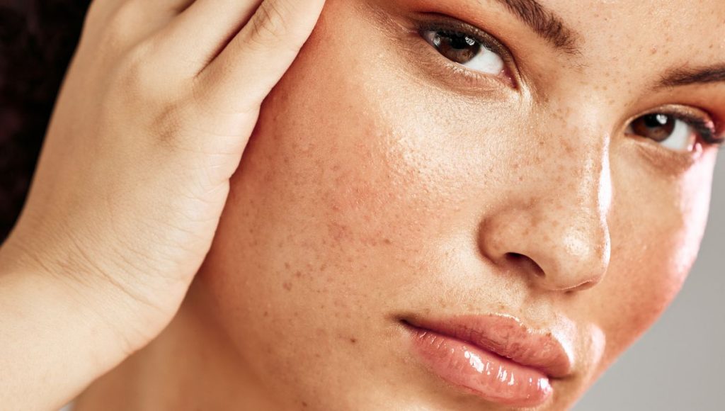 How to Use Essential Oils for Hormonal Acne Naturally and Effectively