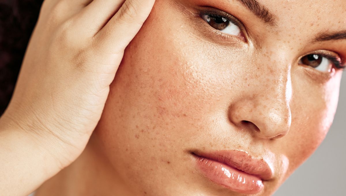How to Use Essential Oils for Hormonal Acne Naturally and Effectively
