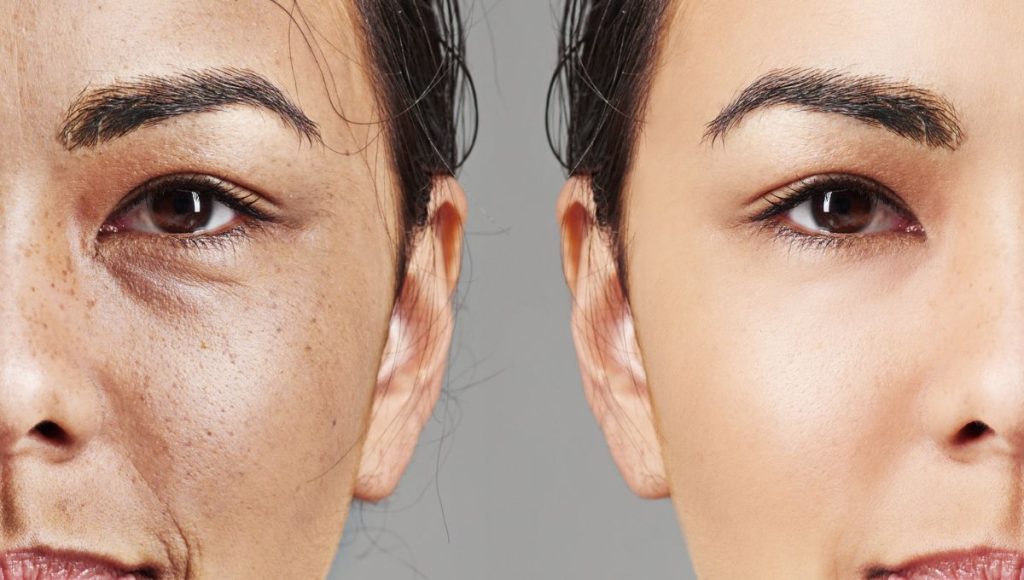 Hyperpigmentation Kojic Acid Before and After: What to Expect for Face, Neck, and Black Skin