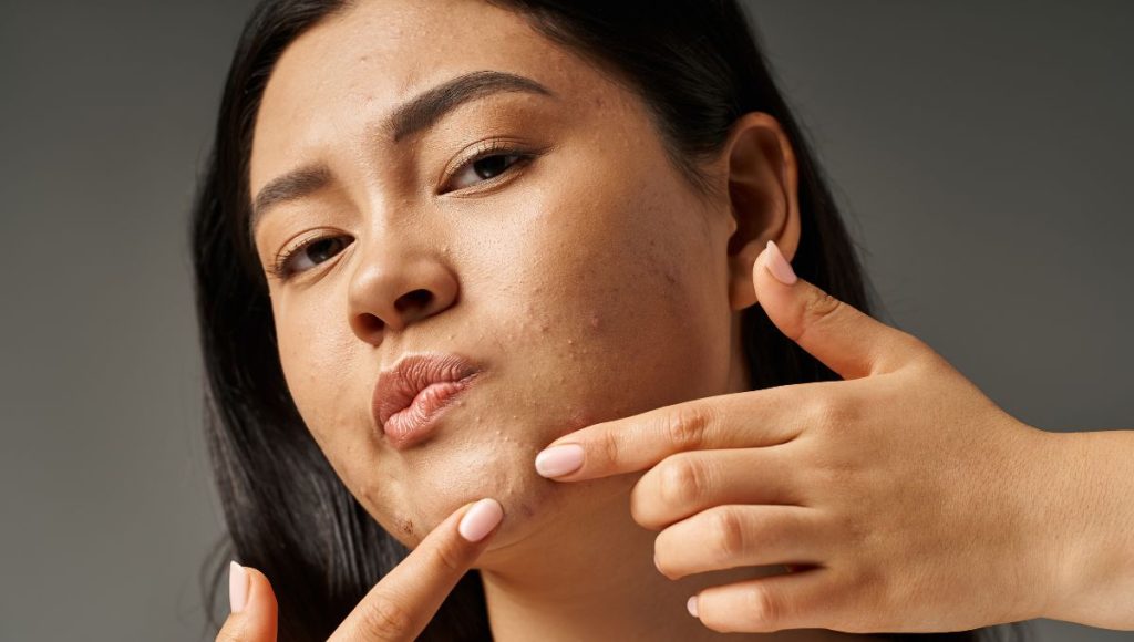 Real Results: Stories of Clearing Acne with the Best Oil for Acne Prone Skin