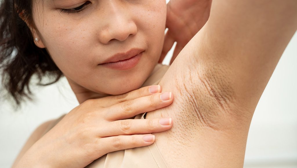 Try At-Home Remedies for Lightening Dark Armpits