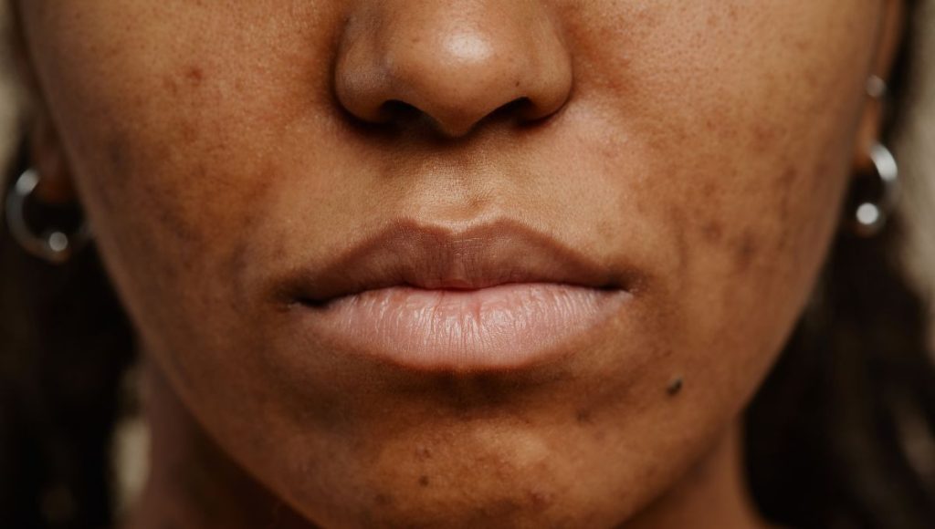 Lifestyle and Habits That May Contribute to Acne Around the Mouth